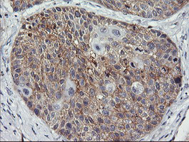 EGFR Antibody - IHC of paraffin-embedded Carcinoma of Human lung tissue using anti-EGFR mouse monoclonal antibody. (Heat-induced epitope retrieval by 10mM citric buffer, pH6.0, 120°C for 3min).