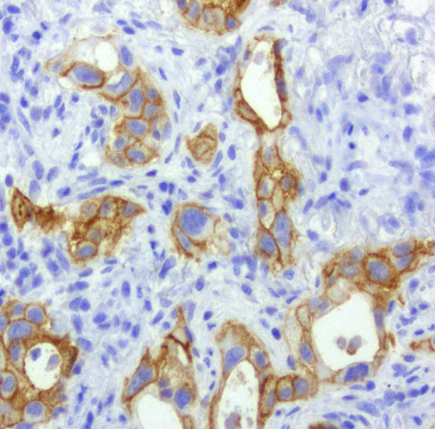 EGFR Antibody - Immunohistochemical staining of paraffin-embedded human lung cancer with mouse anti-EGFR clone UMAB95 1:200 dilution of 400ug/mL using HIER citrate pH6.0 pressure chamber. Expression in lung cancer cells are cytoplasmic and membraneous