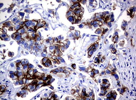 EGFR Antibody - Immunohistochemical staining of paraffin-embedded Carcinoma of Human bladder tissue using anti-EGFR mouse monoclonal antibody.  heat-induced epitope retrieval by 10mM citric buffer, pH6.0, 120C for 3min)