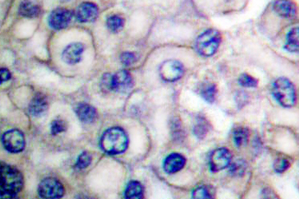 EGFR Antibody - IHC of EGFR (E687) pAb in paraffin-embedded human breast carcinoma tissue.