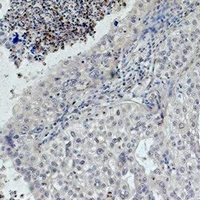 EGFR Antibody - Immunohistochemical analysis of EGFR staining in human lung cancer formalin fixed paraffin embedded tissue section. The section was pre-treated using heat mediated antigen retrieval with sodium citrate buffer (pH 6.0). The section was then incubated with the antibody at room temperature and detected using an HRP conjugated compact polymer system. DAB was used as the chromogen. The section was then counterstained with hematoxylin and mounted with DPX.