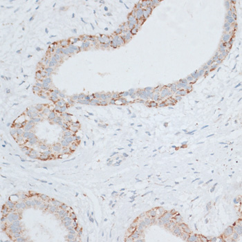EGFR Antibody - Immunohistochemistry of paraffin-embedded human breast cancer using EGFR antibody at dilution of 1:100 (40x lens).