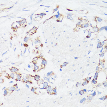 EGFR Antibody - Immunohistochemistry of paraffin-embedded human gastric cancer using EGFR antibody at dilution of 1:150 (40x lens).