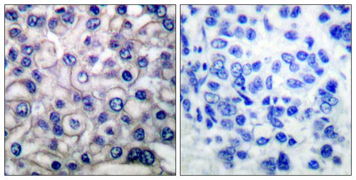 EGFR Antibody - Peptide - + Immunohistochemical analysis of paraffin-embedded human breast carcinoma tissue using EGFR (Ab-693) antibody.