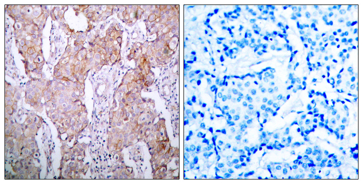 EGFR Antibody - Immunohistochemistry analysis of paraffin-embedded human breast carcinoma, using EGFR (Phospho-Ser1070) Antibody. The picture on the right is blocked with the phospho peptide.