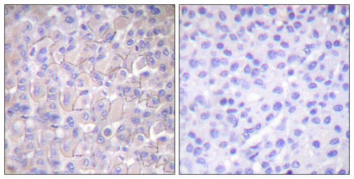 EGFR Antibody - Immunohistochemistry analysis of paraffin-embedded human breast carcinoma, using EGFR (Phospho-Thr693) Antibody. The picture on the right is blocked with the phospho peptide.