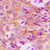 EGFR Antibody - Immunohistochemical analysis of EGFR (pT693) staining in human breast cancer formalin fixed paraffin embedded tissue section. The section was pre-treated using heat mediated antigen retrieval with sodium citrate buffer (pH 6.0). The section was then incubated with the antibody at room temperature and detected using an HRP conjugated compact polymer system. DAB was used as the chromogen. The section was then counterstained with hematoxylin and mounted with DPX.