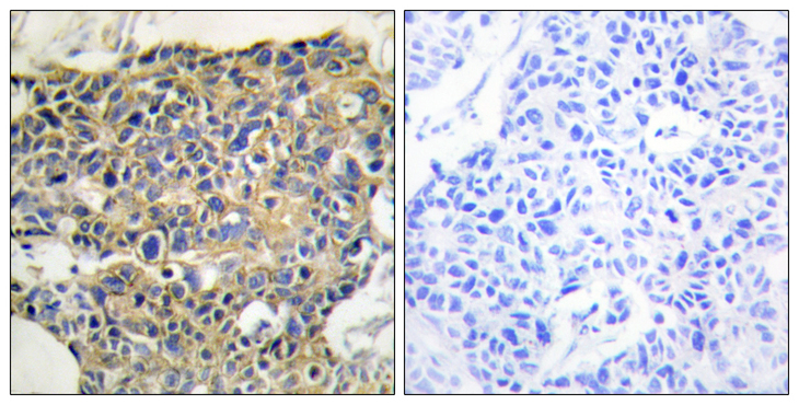 EGFR Antibody - Immunohistochemistry analysis of paraffin-embedded human breast carcinoma, using EGFR (Phospho-Tyr1016) Antibody. The picture on the right is blocked with the phospho peptide.