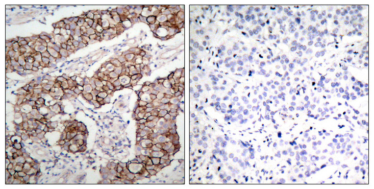 EGFR Antibody - Immunohistochemistry analysis of paraffin-embedded human breast carcinoma, using EGFR (Phospho-Tyr1092) Antibody. The picture on the right is blocked with the phospho peptide.