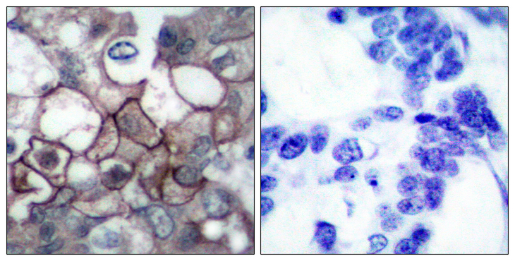 EGFR Antibody - Immunohistochemistry analysis of paraffin-embedded human breast carcinoma, using EGFR (Phospho-Tyr1197) Antibody. The picture on the right is blocked with the phospho peptide.