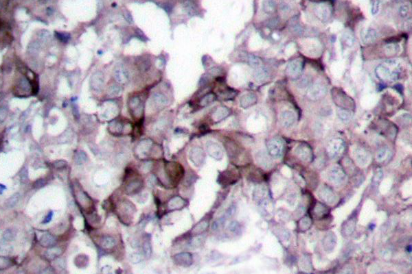 EGFR Antibody - IHC of EGFR (S1166) pAb in paraffin-embedded human breast carcinoma tissue.