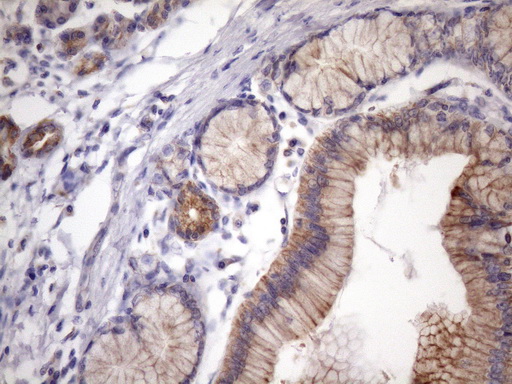EGLN2 / PHD1 Antibody - Immunohistochemical staining of paraffin-embedded Carcinoma of Human pancreas tissue using anti-EGLN2 mouse monoclonal antibody. (Heat-induced epitope retrieval by 1mM EDTA in 10mM Tris buffer. (pH8.5) at 120 oC for 3 min. (1:150)