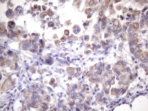 EGLN2 / PHD1 Antibody - Immunohistochemical staining of paraffin-embedded Adenocarcinoma of Human endometrium tissue using anti-EGLN2 mouse monoclonal antibody. (Heat-induced epitope retrieval by 1mM EDTA in 10mM Tris buffer. (pH8.5) at 120 oC for 3 min. (1:150)