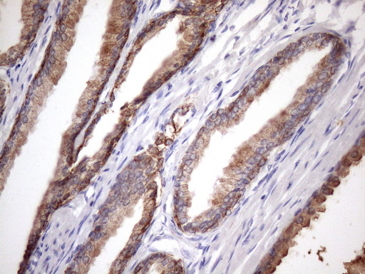 EGLN2 / PHD1 Antibody - Immunohistochemical staining of paraffin-embedded Carcinoma of Human prostate tissue using anti-EGLN2 mouse monoclonal antibody. (Heat-induced epitope retrieval by 1mM EDTA in 10mM Tris buffer. (pH8.5) at 120 oC for 3 min. (1:150)