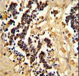EHD3 Antibody - Formalin-fixed and paraffin-embedded human kidney carcinoma reacted with EHD3 Antibody , which was peroxidase-conjugated to the secondary antibody, followed by DAB staining. This data demonstrates the use of this antibody for immunohistochemistry; clinical relevance has not been evaluated.