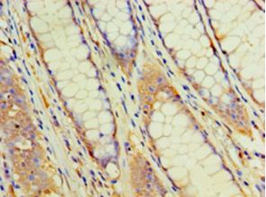 EHHADH / Enoyl-Coa Hydratase Antibody - Immunohistochemistry of paraffin-embedded human colon cancer using antibody at 1:100 dilution.  This image was taken for the unconjugated form of this product. Other forms have not been tested.
