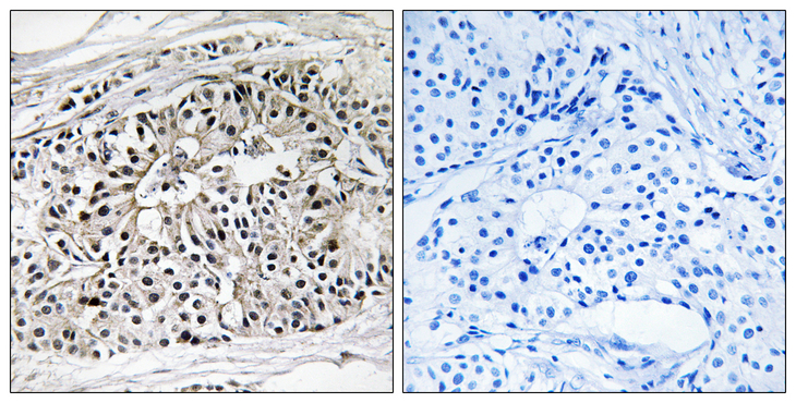 EHHADH / Enoyl-Coa Hydratase Antibody - Immunohistochemistry analysis of paraffin-embedded human breast carcinoma tissue, using EHHADH Antibody. The picture on the right is blocked with the synthesized peptide.