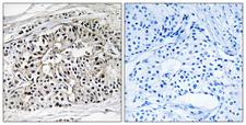 EHHADH / Enoyl-Coa Hydratase Antibody - Immunohistochemistry analysis of paraffin-embedded human breast carcinoma tissue, using EHHADH Antibody. The picture on the right is blocked with the synthesized peptide.