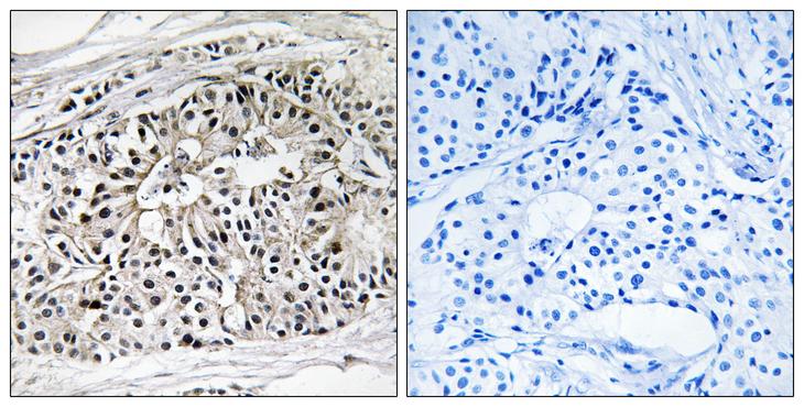 EHHADH / Enoyl-Coa Hydratase Antibody - Peptide - + Immunohistochemistry analysis of paraffin-embedded human breast carcinoma tissue using EHHADH antibody.