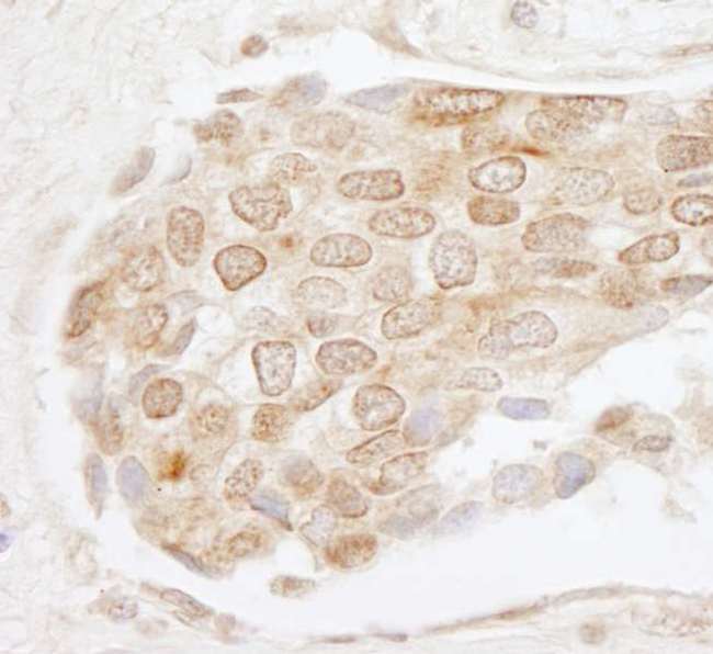 EHMT1 Antibody - Detection of Human EHMT1 by Immunohistochemistry. Sample: FFPE section of human breast carcinoma. Antibody: Affinity purified rabbit anti-EHMT1 used at a dilution of 1:200 (1 Detection: DAB.