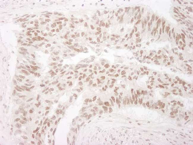 EHMT2 / G9A Antibody - Detection of Human G9A/EHMT2 by Immunohistochemistry. Sample: FFPE section of human lung carcinoma. Antibody: Affinity purified rabbit anti-G9A/EHMT2 used at a dilution of 1:1000 (1 Detection: DAB.