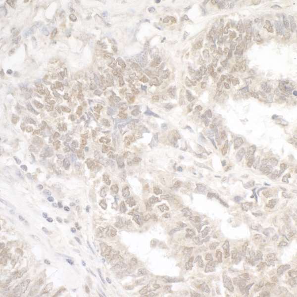 EHMT2 / G9A Antibody - Detection of human G9A/EHMT2 by immunohistochemistry. Sample: FFPE section of human lung carcinoma. Antibody: Affinity purified rabbit anti-G9A/EHMT2 used at a dilution of 1:5,000 (0.2µg/ml). Detection: DAB