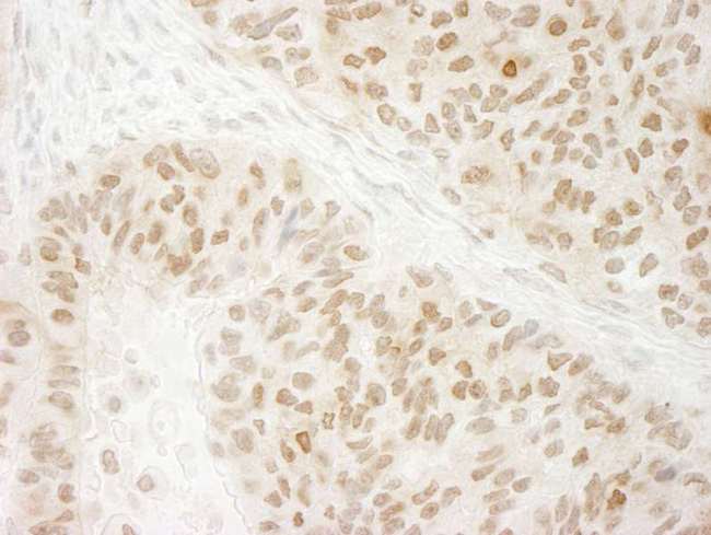 EHMT2 / G9A Antibody - Detection of Human G9A/EHMT2 by Immunohistochemistry. Sample: FFPE section of human breast carcinoma. Antibody: Affinity purified rabbit anti-G9A/EHMT2 used at a dilution of 1:100. Epitope Retrieval Buffer-High pH (IHC-101J) was substituted for Epitope Retrieval Buffer-Reduced pH.