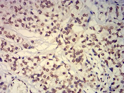 EHMT2 / G9A Antibody - Immunohistochemical analysis of paraffin-embedded bladder cancer tissues using EHMT2 mouse mAb with DAB staining.