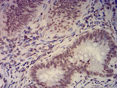 EHMT2 / G9A Antibody - Immunohistochemical analysis of paraffin-embedded rectum cancer tissues using EHMT2 mouse mAb with DAB staining.