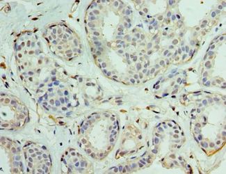 EIF1AX Antibody - Immunohistochemistry of paraffin-embedded human breast cancer using antibody at 1:100 dilution.