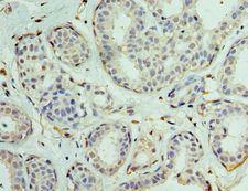 EIF1AX Antibody - Immunohistochemistry of paraffin-embedded human breast cancer using antibody at 1:100 dilution.