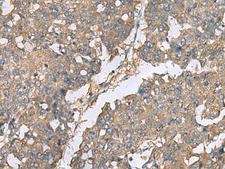 EIF1AX Antibody - Immunohistochemistry of paraffin-embedded Human liver cancer tissue  using EIF1AX Polyclonal Antibody at dilution of 1:65(×200)