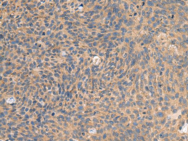 EIF1AX Antibody - Immunohistochemistry of paraffin-embedded Human cervical cancer tissue  using EIF1AX Polyclonal Antibody at dilution of 1:65(×200)