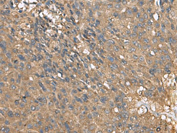 EIF1AX Antibody - Immunohistochemistry of paraffin-embedded Human liver cancer tissue  using EIF1AX Polyclonal Antibody at dilution of 1:105(×200)