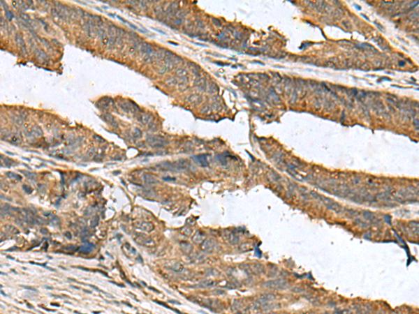 EIF1AX Antibody - Immunohistochemistry of paraffin-embedded Human colorectal cancer tissue  using EIF1AX Polyclonal Antibody at dilution of 1:105(×200)