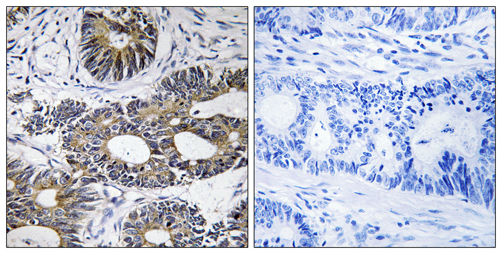 EIF1AY Antibody - Immunohistochemistry analysis of paraffin-embedded human colon carcinoma tissue, using EIF1AY Antibody. The picture on the right is blocked with the synthesized peptide.