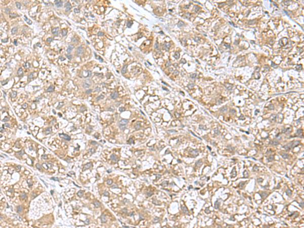 EIF1AY Antibody - Immunohistochemistry of paraffin-embedded Human liver cancer tissue  using EIF1AY Polyclonal Antibody at dilution of 1:55(×200)