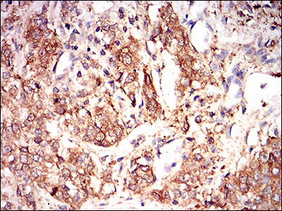EIF2A / EIF2 Alpha Antibody - IHC of paraffin-embedded bladder cancer tissues using EIF2A mouse monoclonal antibody with DAB staining.