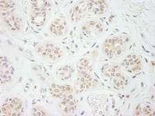 EIF2A / EIF2 Alpha Antibody - Detection of Human eIF2A by Immunohistochemistry. Sample: FFPE section of human breast carcinoma. Antibody: Affinity purified rabbit anti-eIF2A used at a dilution of 1:1000 (1 Detection: DAB.