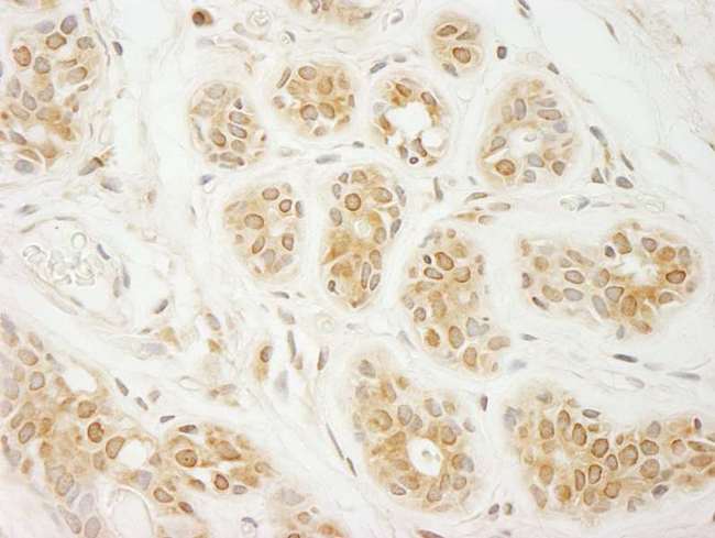 EIF2A / EIF2 Alpha Antibody - Detection of Human eIF2A by Immunohistochemistry. Sample: FFPE section of human breast carcinoma. Antibody: Affinity purified rabbit anti-eIF2A used at a dilution of 1:200 (1 Detection: DAB.