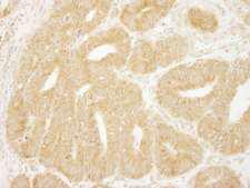 EIF2A / EIF2 Alpha Antibody - Detection of Human eIF2A by Immunohistochemistry. Sample: FFPE section of human colon carcinoma. Antibody: Affinity purified rabbit anti-eIF2A used at a dilution of 1:250. Epitope Retrieval Buffer-High pH (IHC-101J) was substituted for Epitope Retrieval Buffer-Reduced pH.