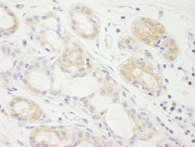 EIF2A / EIF2 Alpha Antibody - Detection of Human eIF2A by Immunohistochemistry. Sample: FFPE section of human breast carcinoma. Antibody: Affinity purified rabbit anti-eIF2A used at a dilution of 1:250.