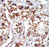 EIF2AK1 Antibody - Formalin-fixed and paraffin-embedded human cancer tissue reacted with the primary antibody, which was peroxidase-conjugated to the secondary antibody, followed by AEC staining. This data demonstrates the use of this antibody for immunohistochemistry; clinical relevance has not been evaluated. BC = breast carcinoma; HC = hepatocarcinoma.