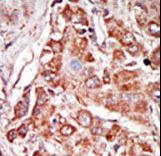 EIF2AK2 / PKR Antibody - Formalin-fixed and paraffin-embedded human cancer tissue reacted with the primary antibody, which was peroxidase-conjugated to the secondary antibody, followed by DAB staining. This data demonstrates the use of this antibody for immunohistochemistry; clinical relevance has not been evaluated. BC = breast carcinoma; HC = hepatocarcinoma.