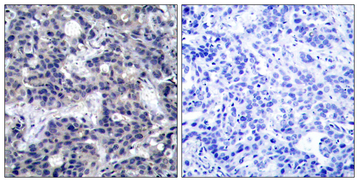 EIF2AK2 / PKR Antibody - Immunohistochemistry analysis of paraffin-embedded human breast carcinoma tissue, using PKR Antibody. The picture on the right is blocked with the synthesized peptide.
