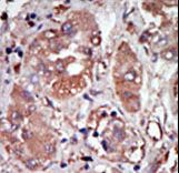 EIF2AK2 / PKR Antibody - Formalin-fixed and paraffin-embedded human cancer tissue reacted with the primary antibody, which was peroxidase-conjugated to the secondary antibody, followed by DAB staining. This data demonstrates the use of this antibody for immunohistochemistry; clinical relevance has not been evaluated. BC = breast carcinoma; HC = hepatocarcinoma.