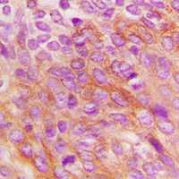 EIF2AK2 / PKR Antibody - Immunohistochemical analysis of PKR staining in human breast cancer formalin fixed paraffin embedded tissue section. The section was pre-treated using heat mediated antigen retrieval with sodium citrate buffer (pH 6.0). The section was then incubated with the antibody at room temperature and detected using an HRP conjugated compact polymer system. DAB was used as the chromogen. The section was then counterstained with hematoxylin and mounted with DPX.