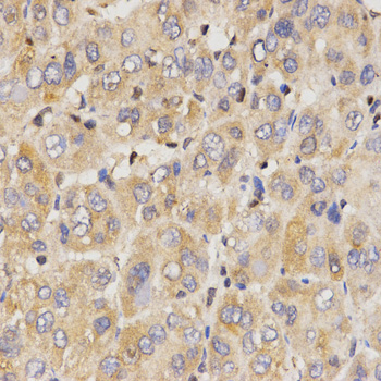 EIF2AK2 / PKR Antibody - Immunohistochemistry of paraffin-embedded human liver cancer tissue.