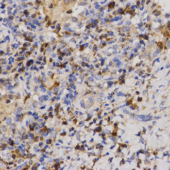 EIF2AK2 / PKR Antibody - Immunohistochemistry of paraffin-embedded human lung cancer using Eif2ak2 antibody at dilution of 1:200 (40x lens).