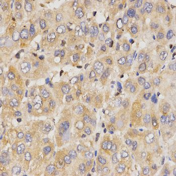 EIF2AK2 / PKR Antibody - Immunohistochemistry of paraffin-embedded human liver cancer using Eif2ak2 antibody at dilution of 1:200 (40x lens).